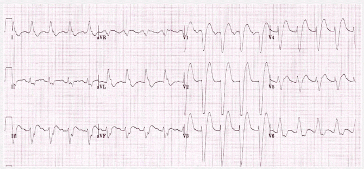 Điện tâm đồ biểu thị tình trạng QRS Block nhánh trái ECG